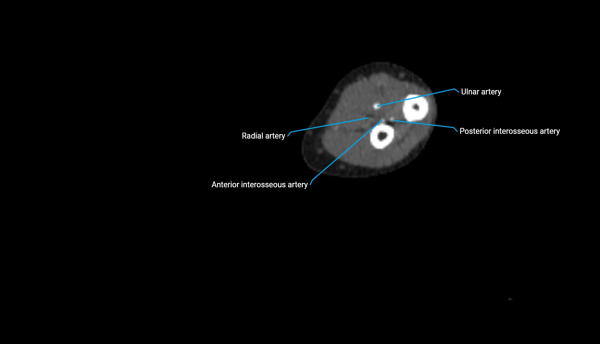 CTA upper limb axial cross sectional anatomy labelled image 161 (2).webp